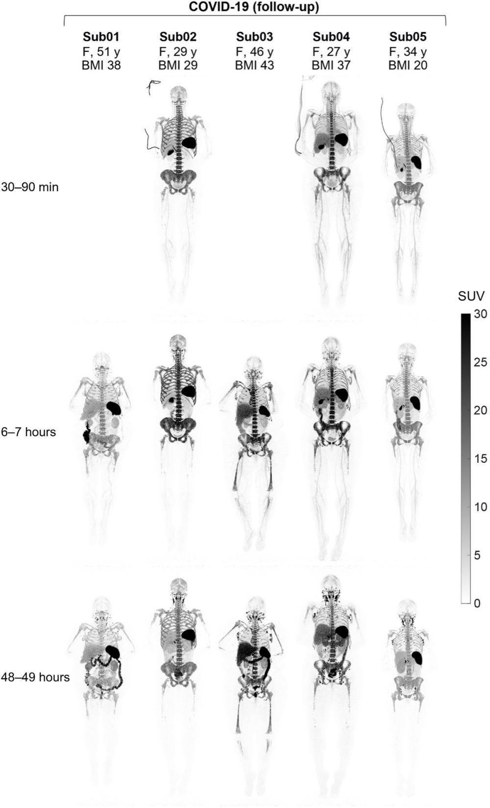 Use of total-body PET imaging to identify deep-tissue SARS-CoV-2