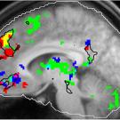 Image: scan of brain with colored areas in various places